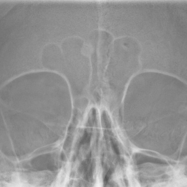 radiografia senos